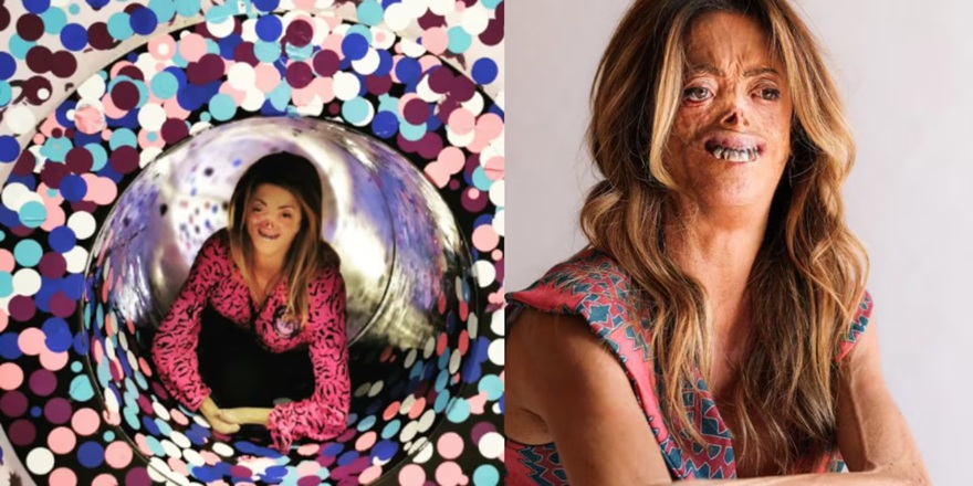 Una extraña enfermedad le devoró la cara y las manos: ahora es influencer y una inspiración